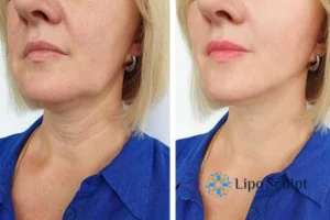 Double chin before and after Hi-Fu treatment 4 Book your double chin treatment Apsley today! We are here to help!