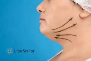 Double chin before and after Hi-Fu treatment 3 Boost your confidence with a Double chin treatment Apsley