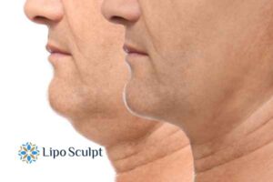 Double chin before and after Hi-Fu treatment 2 Double chin treatment Apsley from Lipo Sculpt - feel more confident today!