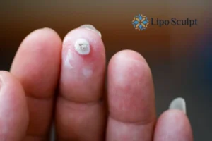 Cryopen Top 5 Treatable Conditions 4 Do you have a persistent wart of verruca that you cannot shit? Cryopen Apsley treatment will work call us NOW!